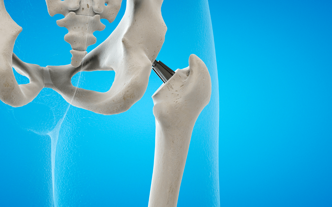 Hip & Total Hip Replacement Surgery, Treatment