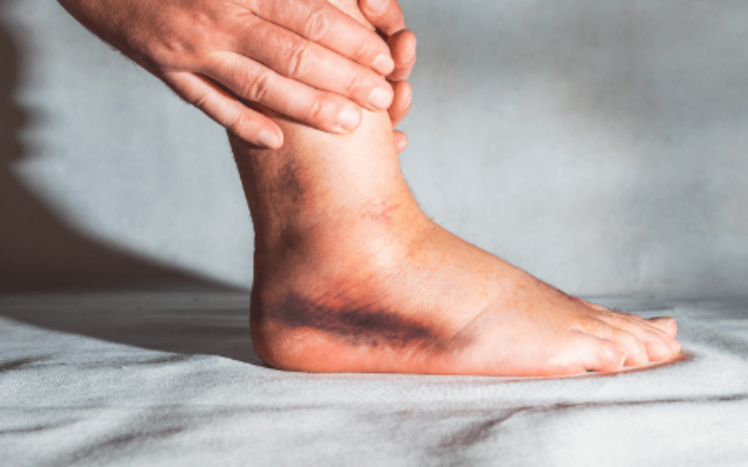 How Wharton’s Jelly Stem Cell Therapy Can Help Treat Ankle Osteoarthritis