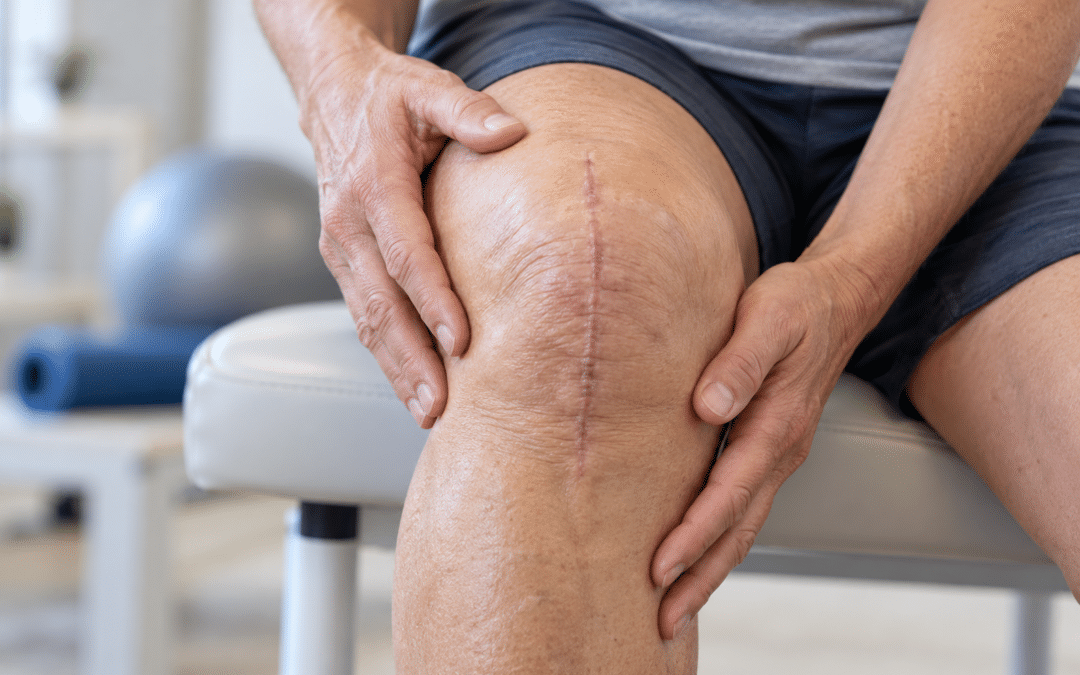 Scar Tissue After Knee Replacement: When Stiffness Becomes A Problem