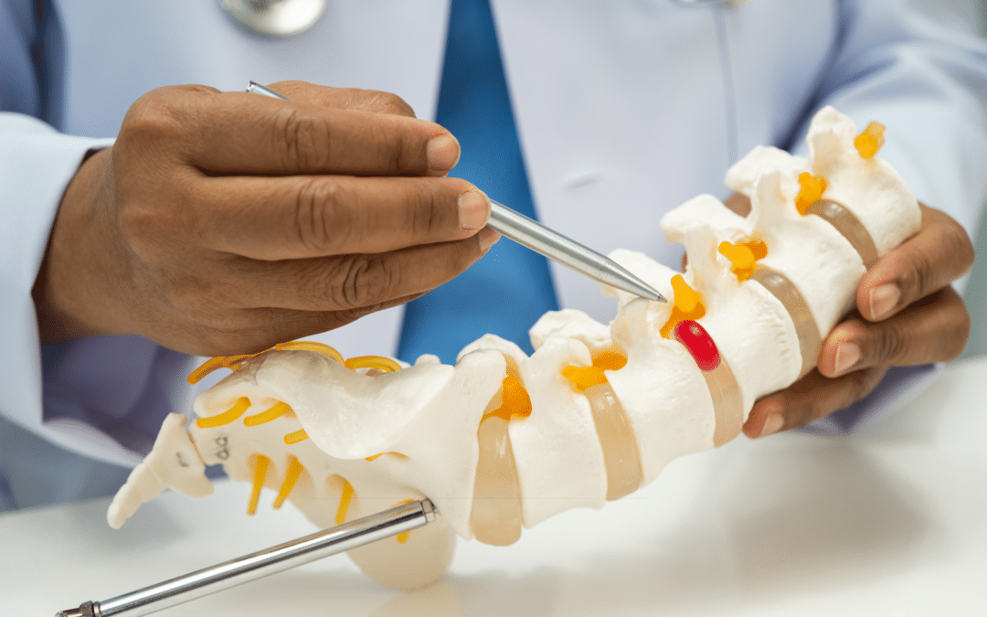 Medical illustration of a bulging spinal disc